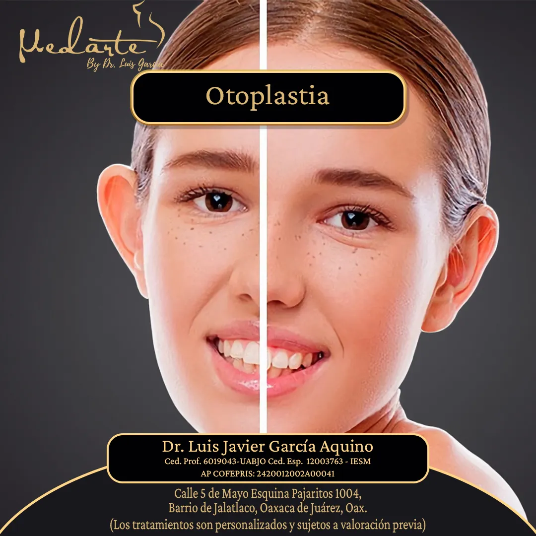 Otoplastia